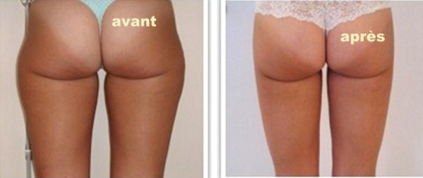 La liposuccion : une chirurgie esthétique de la silhouette La liposuccion : une chirurgie esthétique de la silhouette