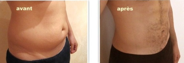 La liposuccion : une chirurgie esthétique de la silhouette La liposuccion : une chirurgie esthétique de la silhouette
